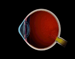 astigmatism